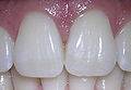 Dientes blancos