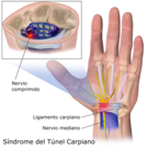 síndrome del túnel carpiano